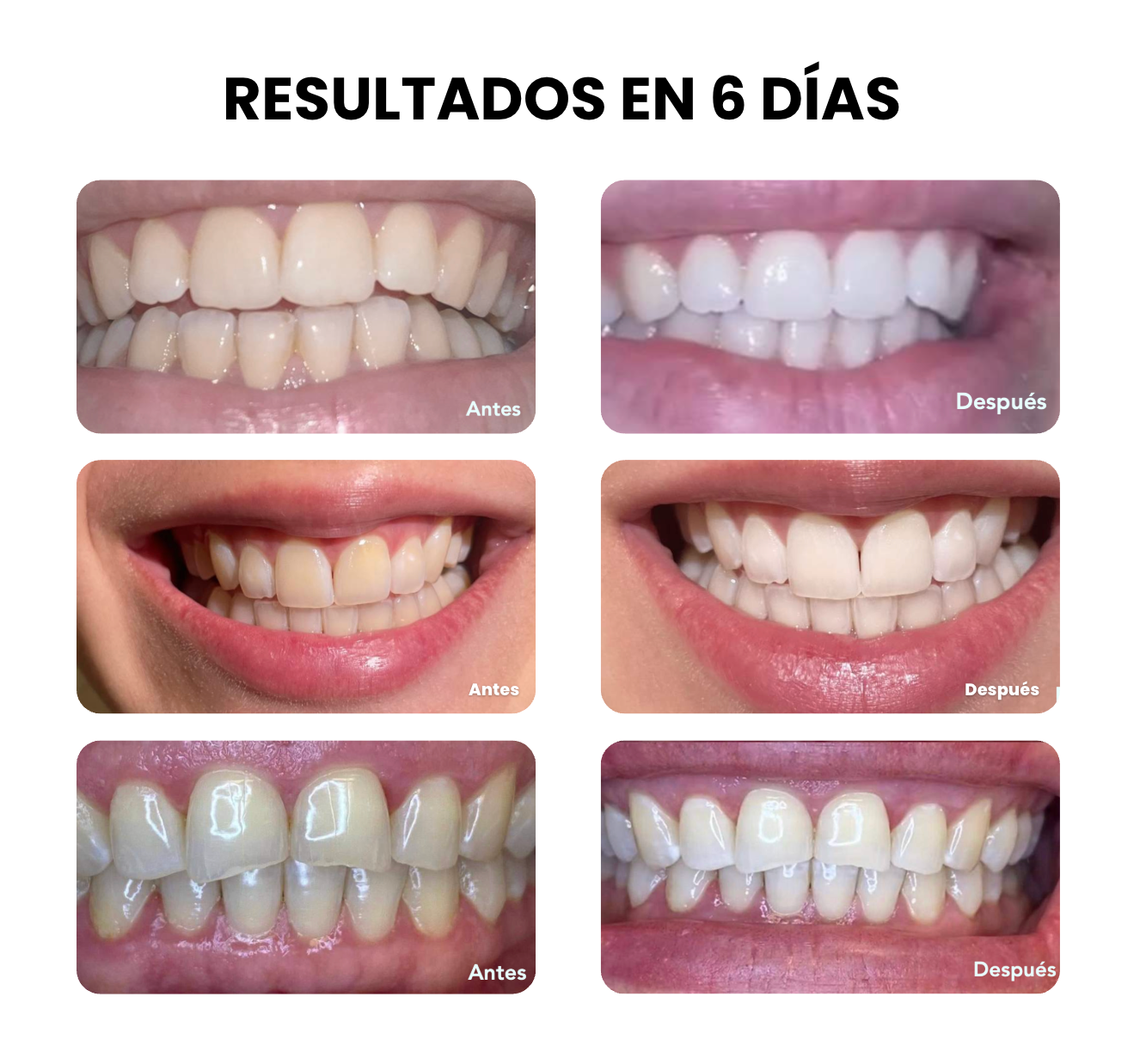 Kit de Blanqueamiento